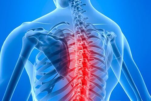 A nyaki gerinc osteochondrosisa: tünetek és szindrómák, kezelés, megelőzés - Hondrox
